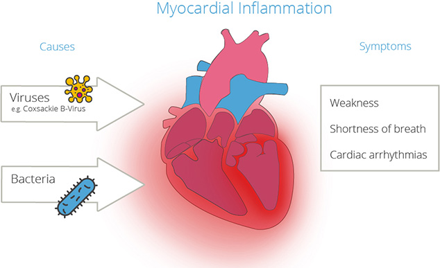 Viruses and bacteria: the cause of infectious heart muscle inflammation
