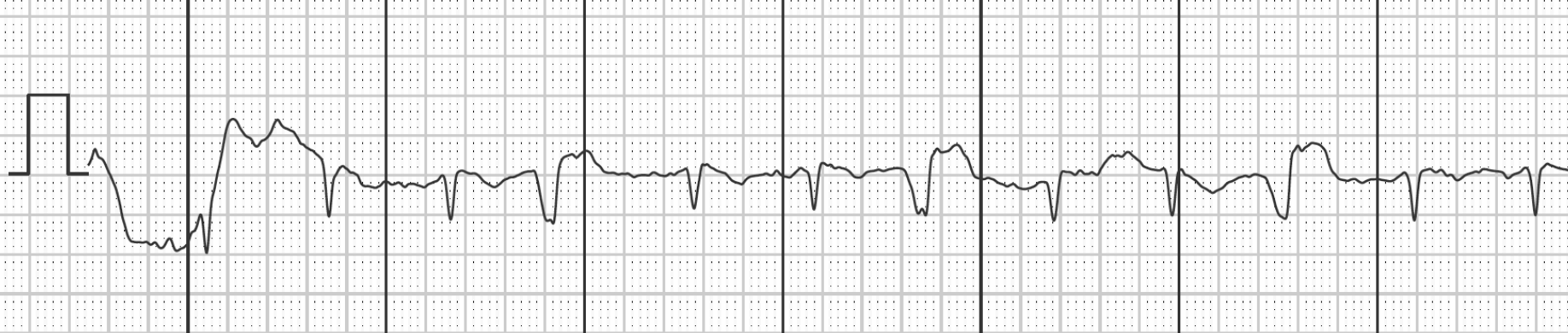 Graph der unspezifizierten Ableitung eines 1-Kanal-EKGs 