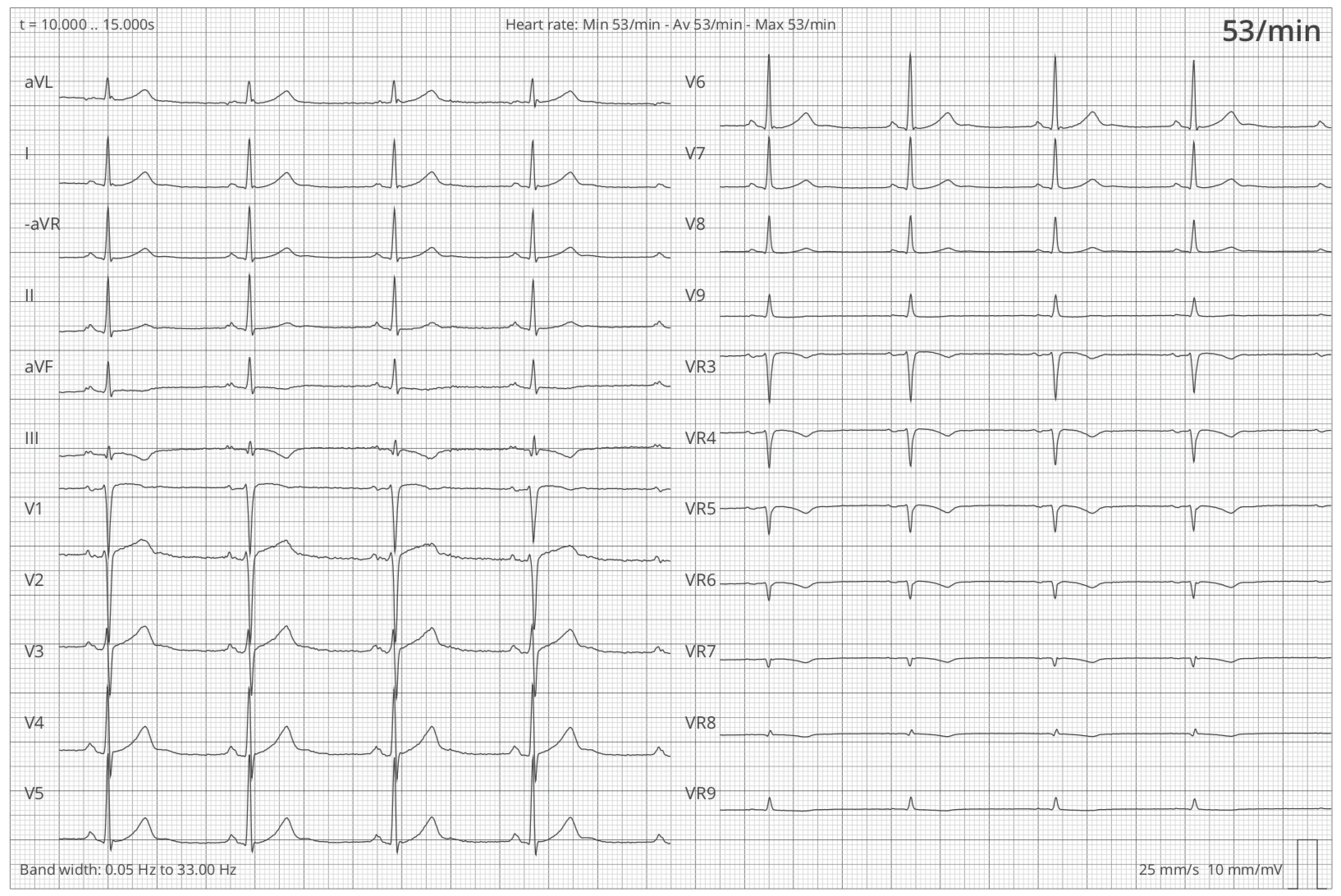 Graph der Ableitungen (I, II, III, aVR, aVL, aVF, V1-V9, VR2-VR9) eines 12 Kanal-EKGs