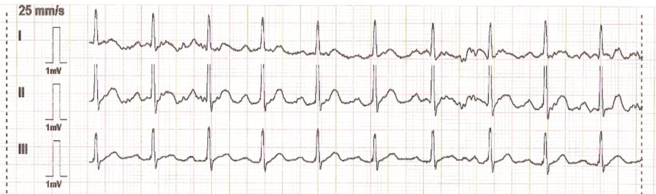 Graph der unspezifizierten Ableitungen eines 3-Kanal-EKGs 