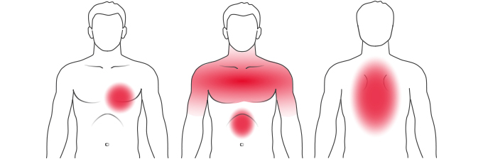 Darstellung der typischsten Herzinfarktsymptome