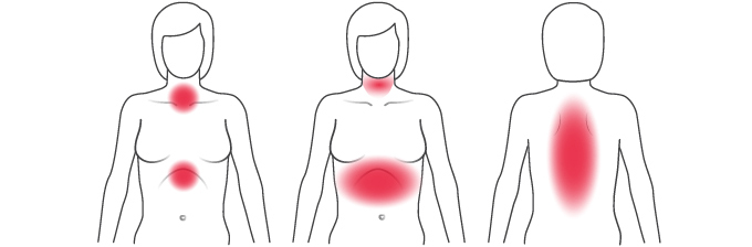 Darstellung häufiger körperlicher Anzeichen für einen Herzinfarktanzeichen bei Frauen 