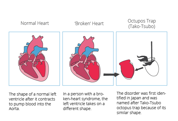 takotsubo cardiomyopathy causes
