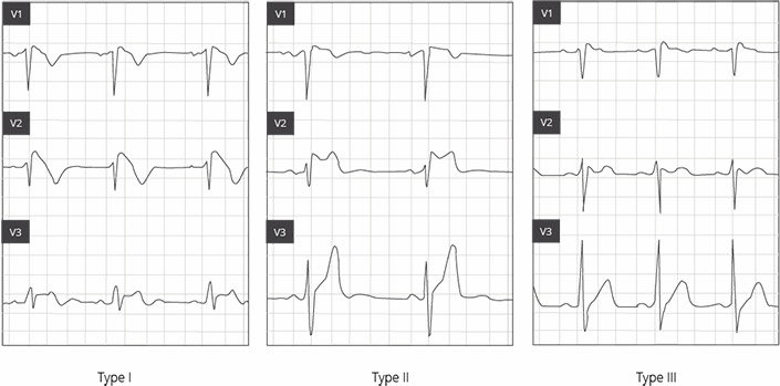 Brugada syndrome: reliably diagnosed only by means of an ECG