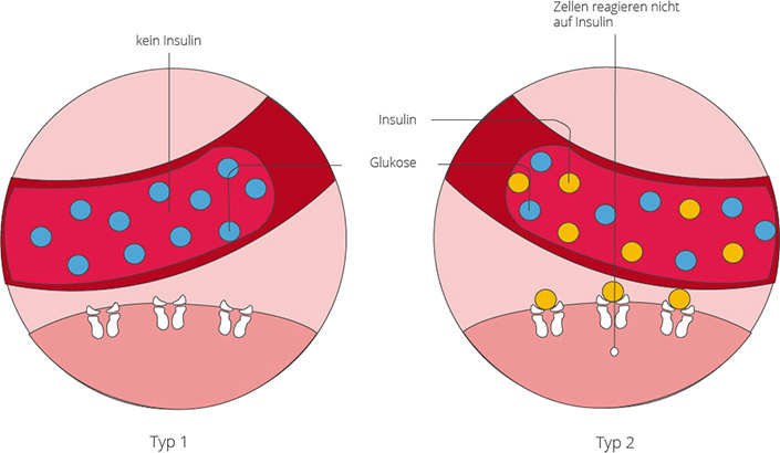 Die Formen von Diabetes mellitus: Diabetes Typ 1 und Typ 2