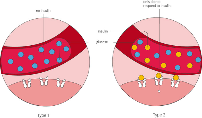 The types of diabetes mellitus: type 1 and type 2