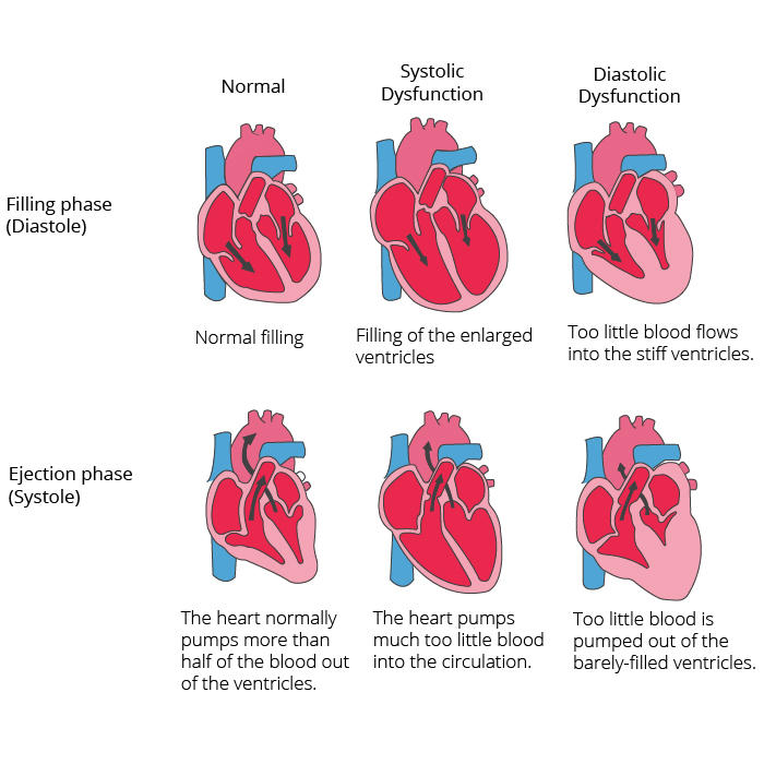 Graphical representation of a healthy heart compared to systolic dysfunction and diastolic dysfunction