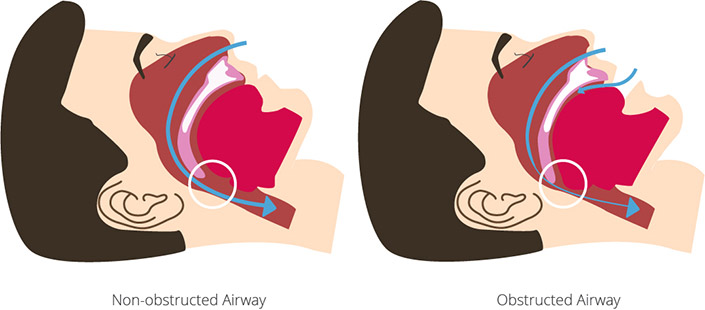 Obstructive sleep apnea due to obstructed airway