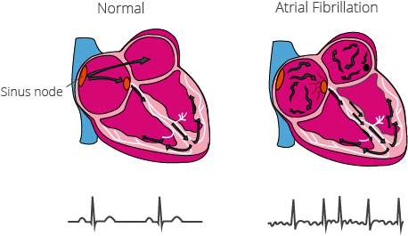 With atrial fibrillation, electrical impulses are transmitted uncontrollably