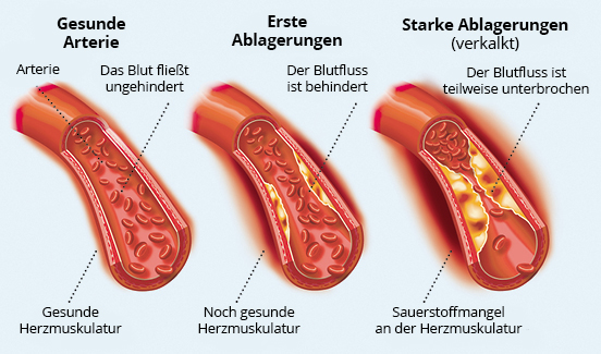 Schematische Darstellung einer Arterie in drei Arteriosklerose-Stadien 