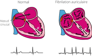 En cas de fibrillation auriculaire, les impulsions électriques générent des contractions désordonnées