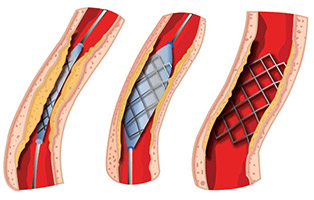 A stent is placed in the narrow portion of the vessel where it is expanded using pressure